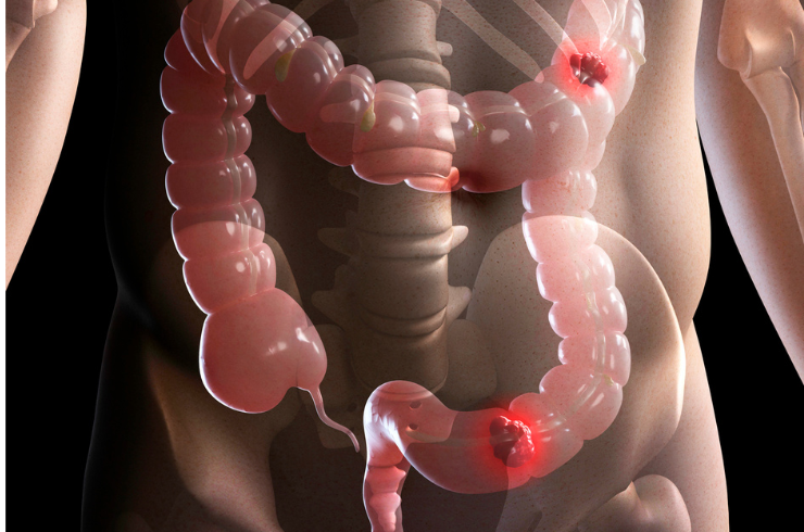 Incomplete Bowel Evacuation